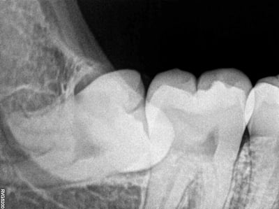 The First Signs of Wisdom Teeth Coming In