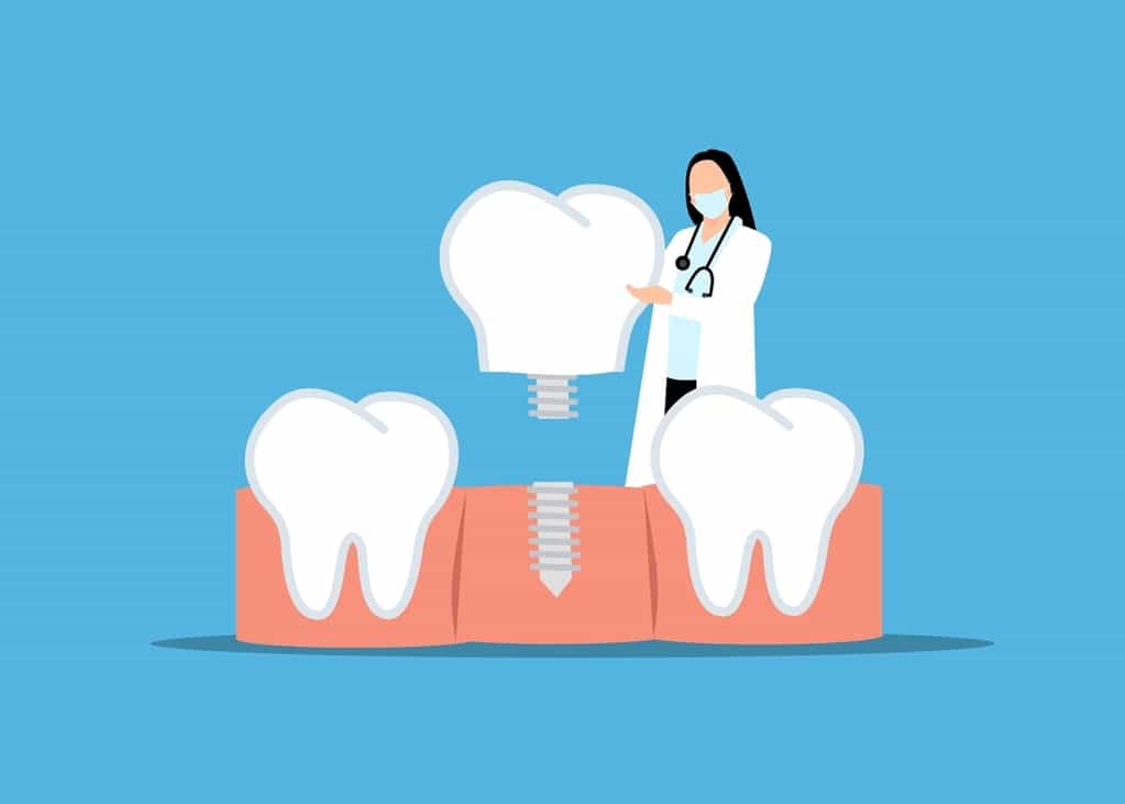 candidatos implantes dentales