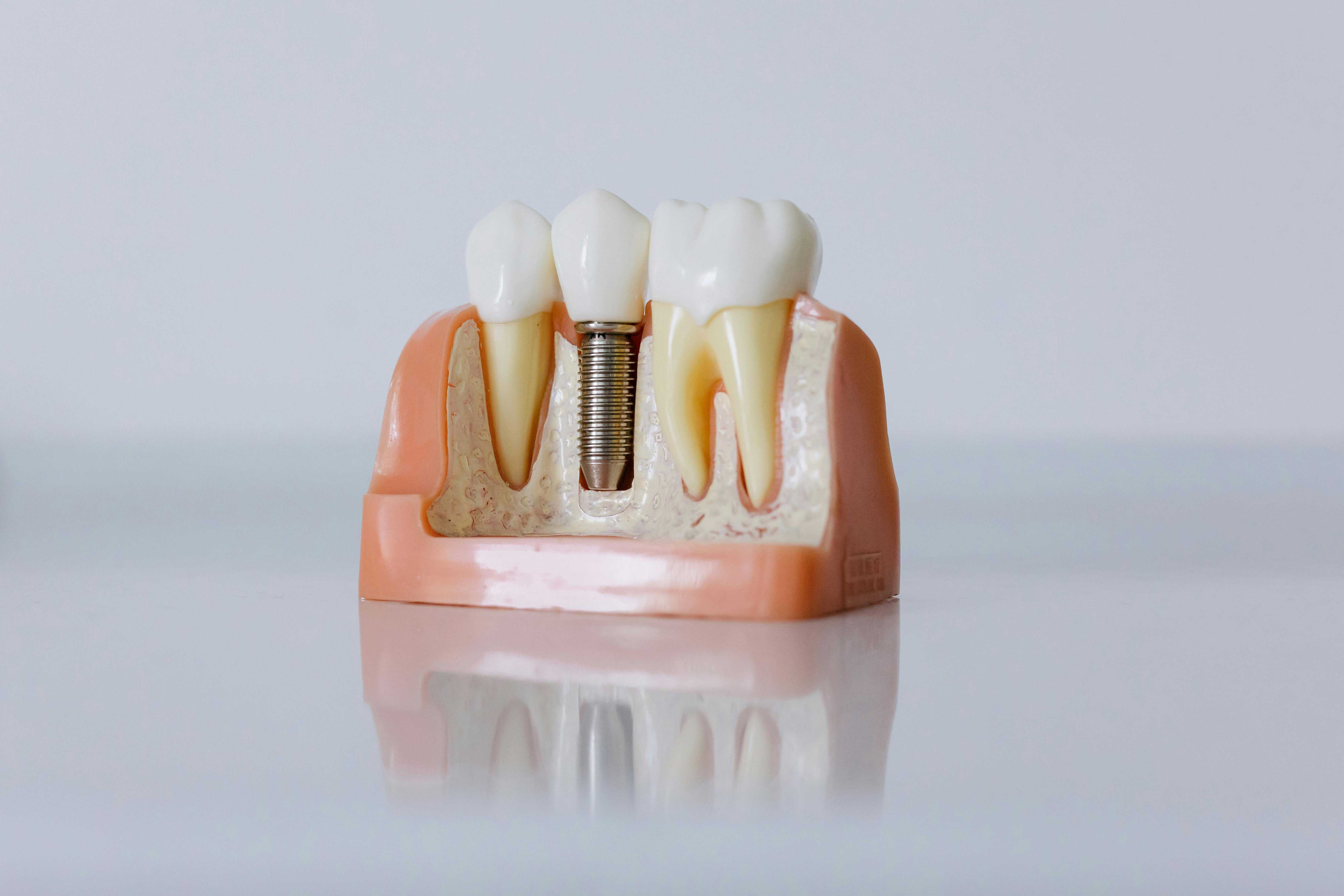 implantes dentales Lima
